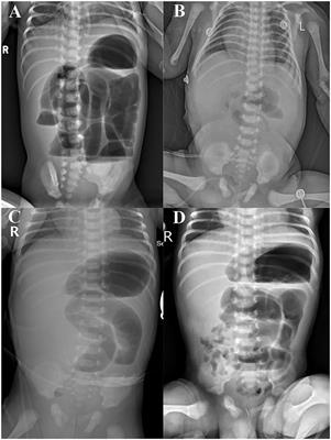 Meconium Peritonitis, Intestinal Atresia Combined With Biliary Atresia: A Case Report